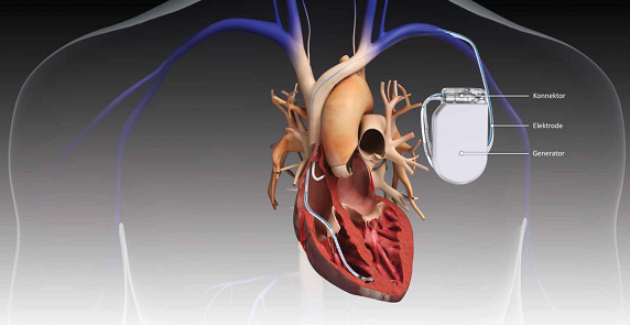 implantable medical devices