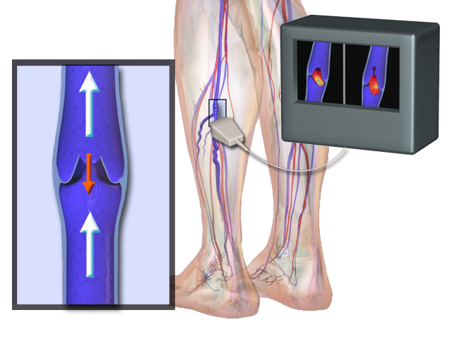 Varicose Veins Treatment Devices Market