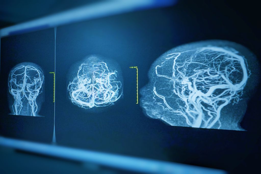 Brain Aneurysm Treatment