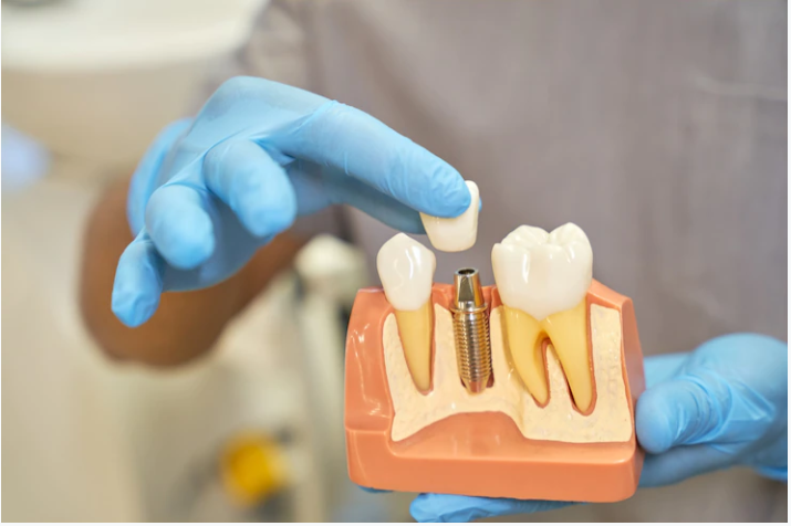 Dental Implants Market