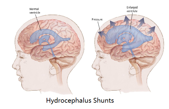 Hydrocephalus Shunts Market