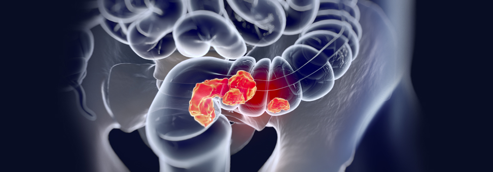 Colorectal Cancer Diagnostics Market